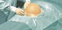 Секцио-комплект III для кесарева сечения с мешком для сбора жидкости (2573183) 4 шт. операция "Кесарева сечения", горизонтальное положение